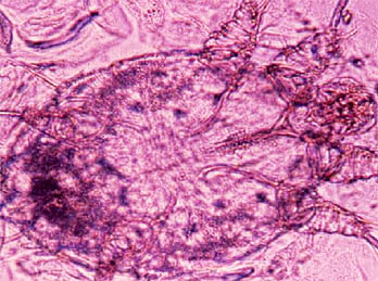 Avances en el tratamiento de escarbosis